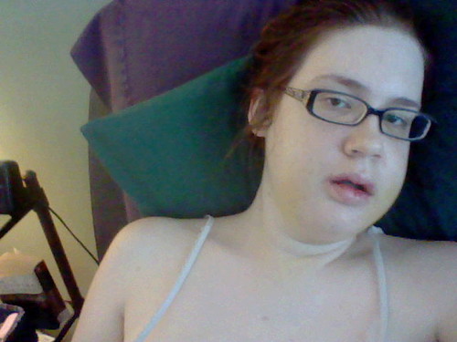 Me recovering from jaw surgery, face swollen disproportionately, propped up sideway on pillows in bed.